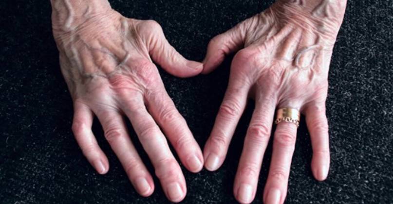 preparati medicinali per artrite reumatoide