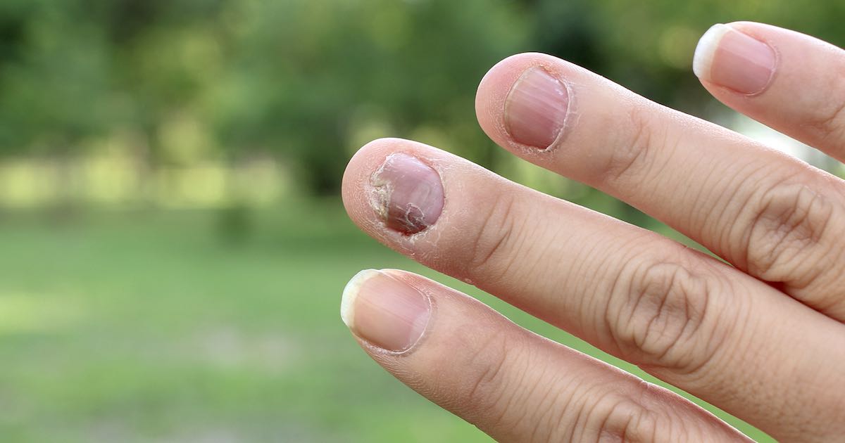 Funghi delle unghie