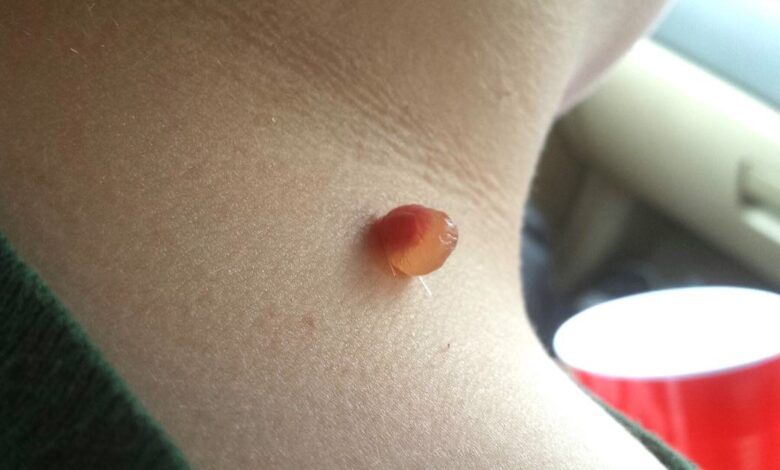 Fibromi penduli