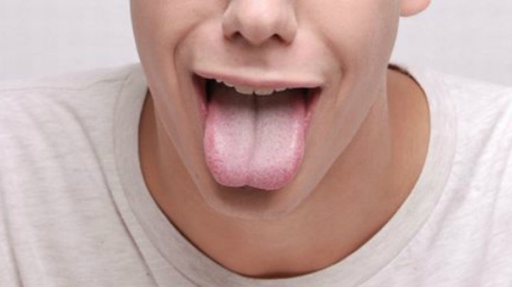 Carenze nutrizionali, l'aspetto ed il colore della lingua rivelano deficit di vitamine
