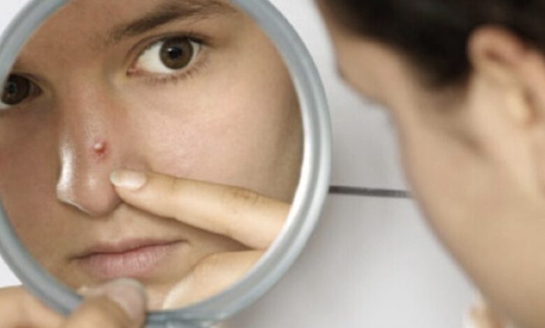 Come eliminare i brufoli dal viso con rimedi naturale