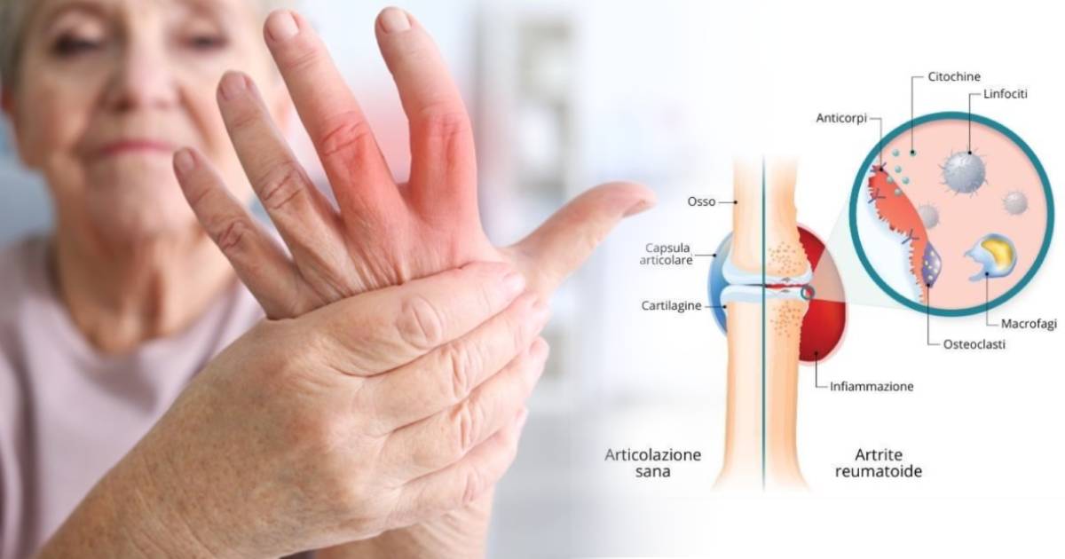 artrite reumatoide infiammazioni