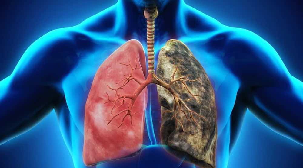 depurare i polmoni dallo smog catarro